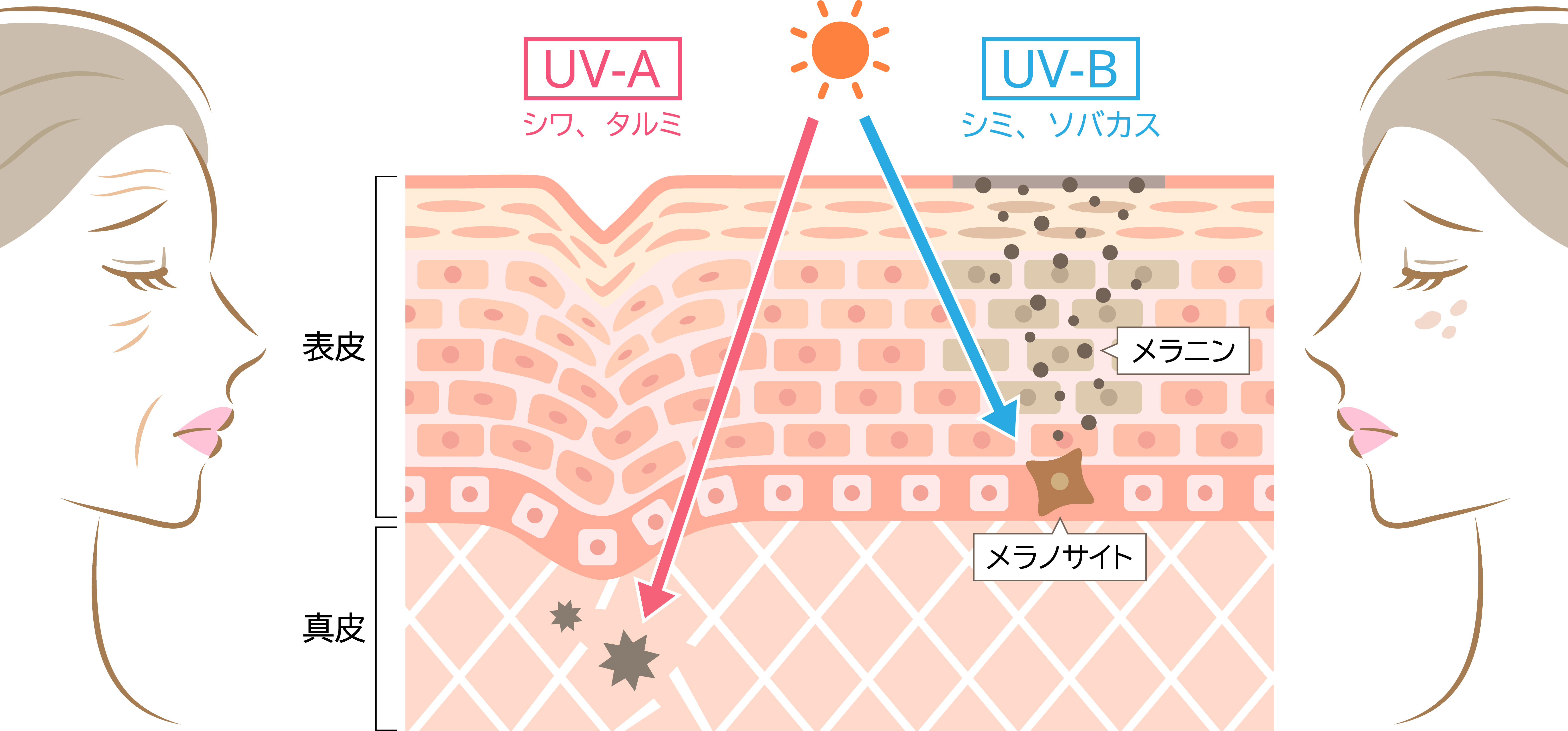 UV-Aによるシワ・タルミとUV-Bによるシミ・ソバカスの発生メカニズムを示す、肌の断面と女性の横顔の比較イラスト