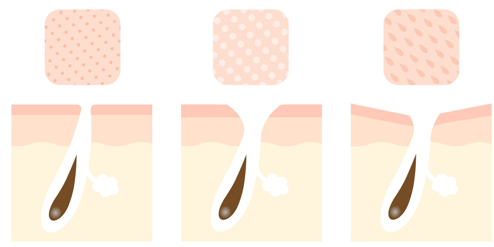 代表的な毛穴の種類（開き・たるみ・つまり）の断面イラスト