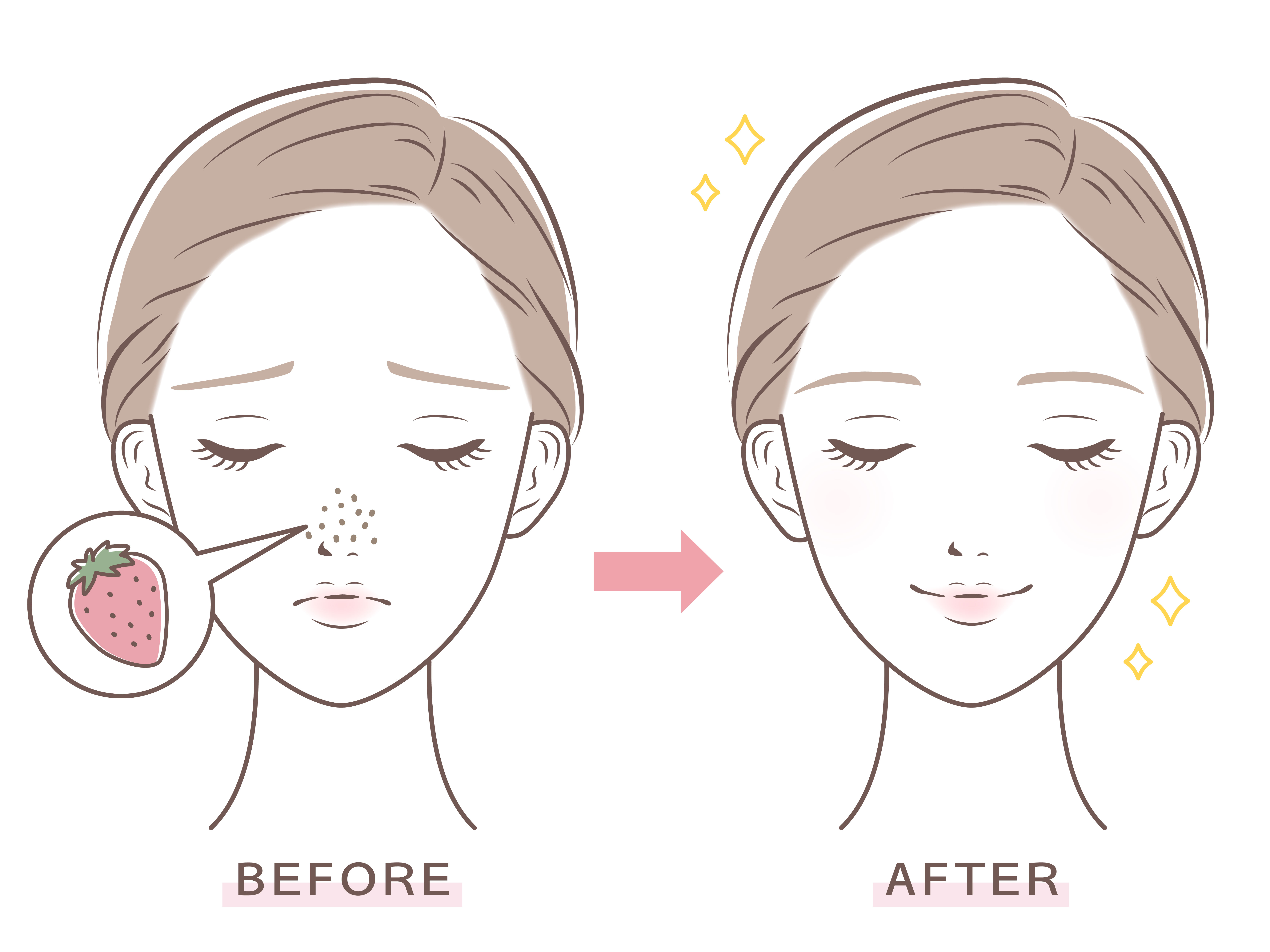 スキンケアによる鼻の黒ずみの変化を示したビフォーアフターのイメージイラスト。