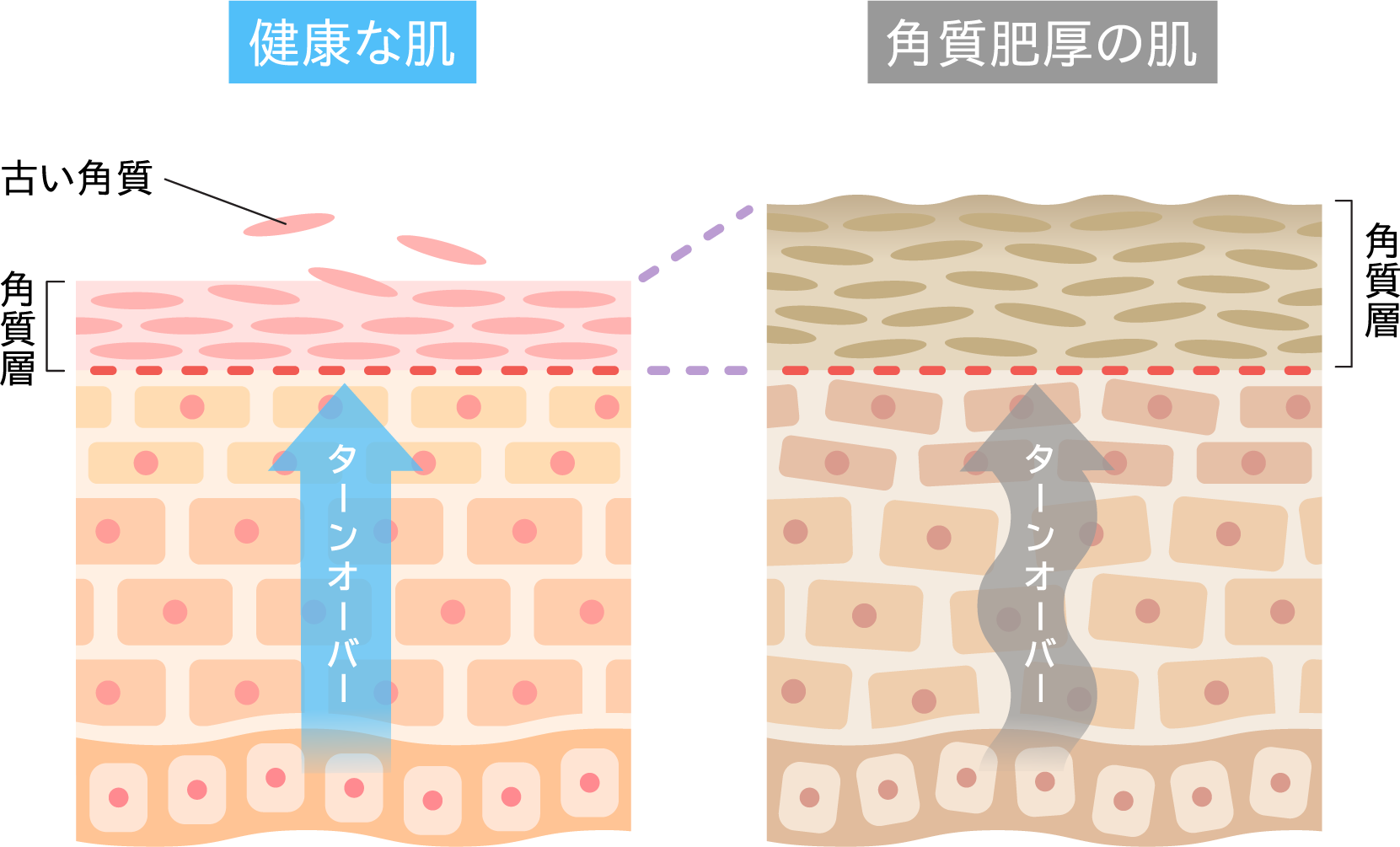 「健康な肌」と、ターンオーバーが乱れて角質層が厚くなった「角質肥厚の肌」の状態を比較した解説イラスト。