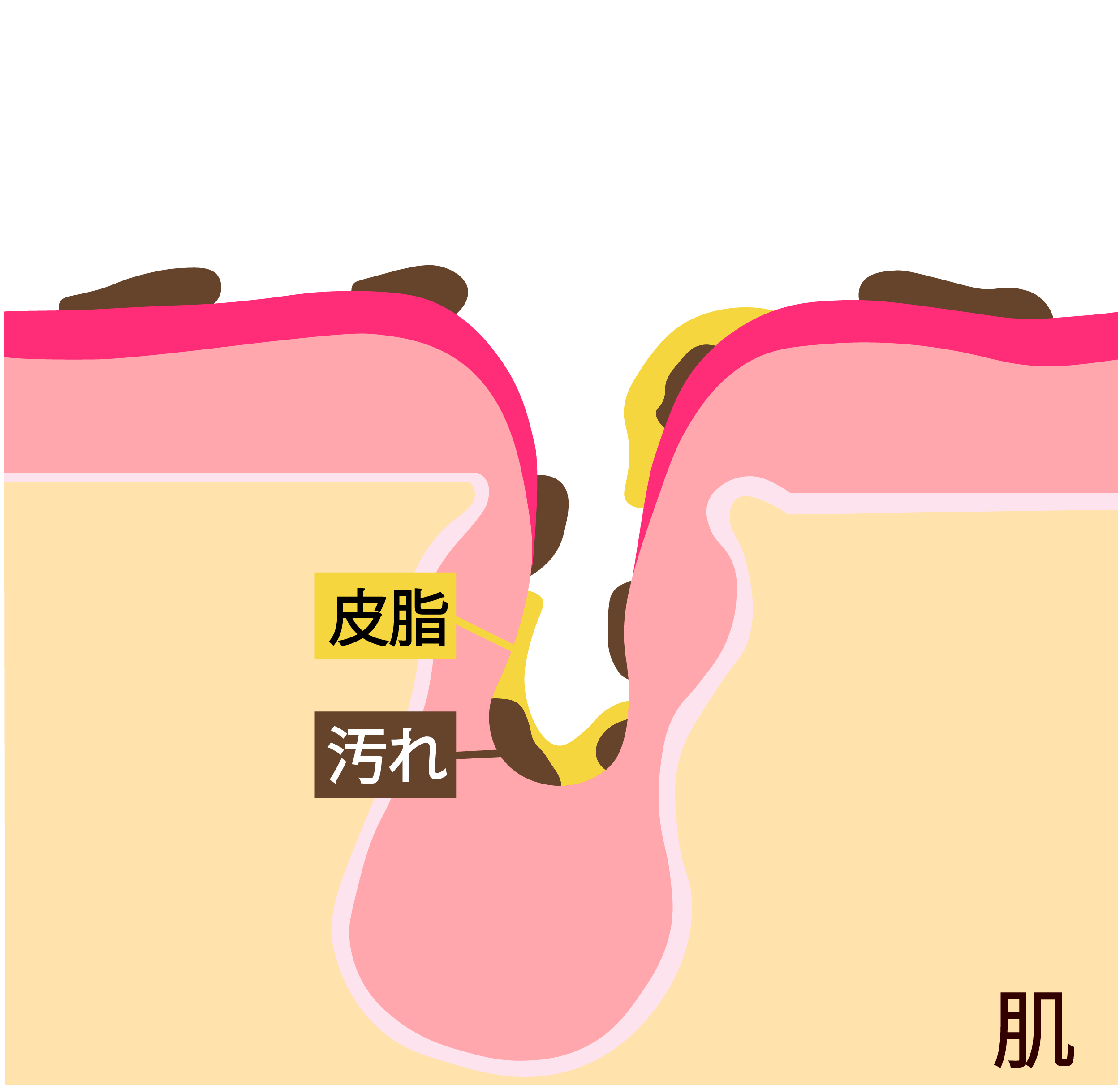 皮脂」と「汚れ」が毛穴や肌の表面に溜まる様子を描いた毛穴の断面イラスト図